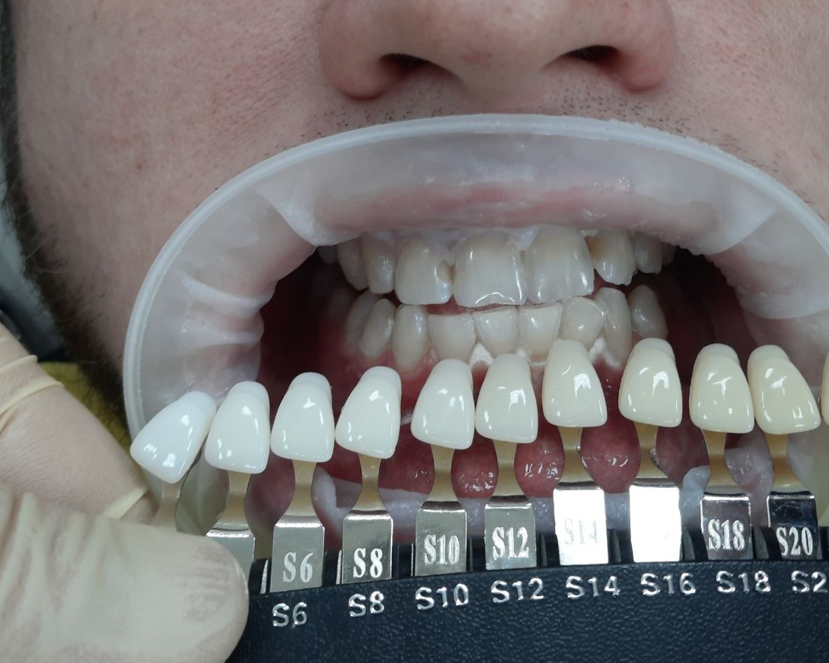 Кейс имплантации — до/после