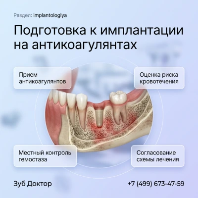 Подготовка к имплантации на антикоагулянтах Подготовка к имплантации на антикоагулянтах