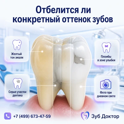 Как понять, отбелится ли оттенок зубов