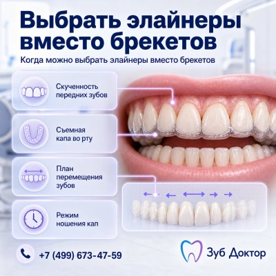 Выбрать элайнеры вместо брекетов