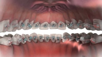 Скрытые Брекеты: Тайное Оружие для Идеальной Улыбки Скрытые Брекеты: Тайное Оружие для Идеальной Улыбки