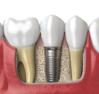 Послеоперационный период после имплантации зубов Послеоперационный период после имплантации зубов