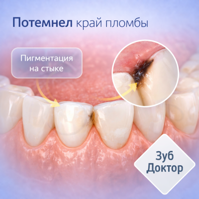 Потемнел край пломбы