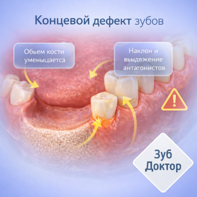 Концевой дефект