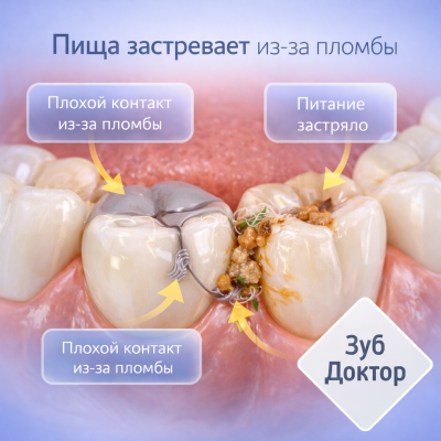 Пища застревает из-за пломбы