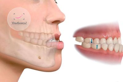 Продолжительность Лечения у Ортодонта: Что Ожидать Продолжительность Лечения у Ортодонта: Что Ожидать