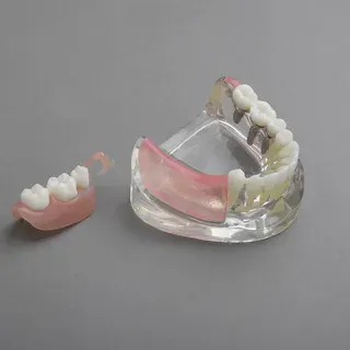 Съемные частичные зубные протезы: когда и кому они подходят Съемные частичные зубные протезы: когда и кому они подходят