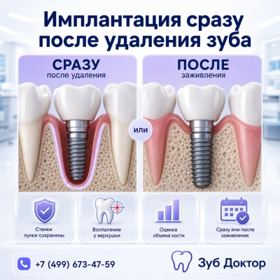 Удалять корень заранее или ставить имплант сразу