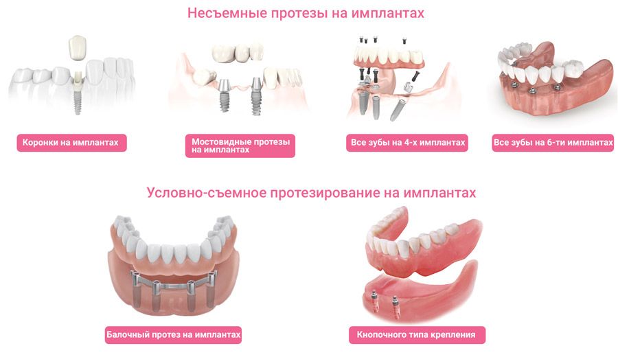 Протезирование на имплантах Протезирование на имплантах