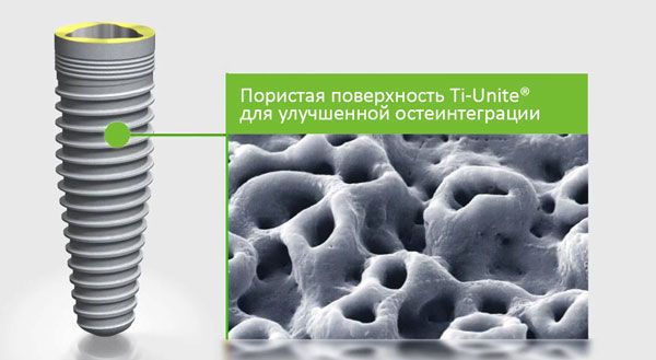 Технология Ti-Unite®: ускорение остеоинтеграции имплантов Nobel Технология Ti-Unite®: ускорение остеоинтеграции имплантов Nobel
