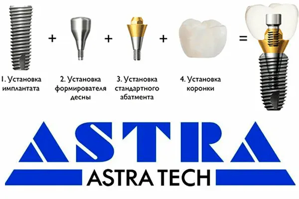 Цены на имплантацию Astra Tech Цены на имплантацию Astra Tech