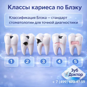 Классы кариеса по Блэку
