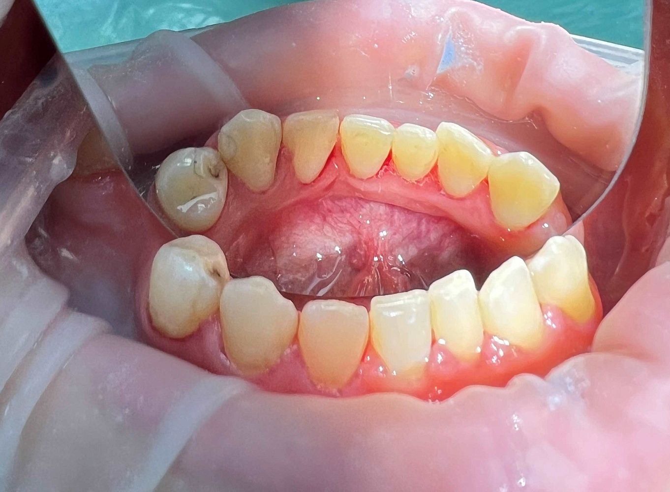 Результат после лечения