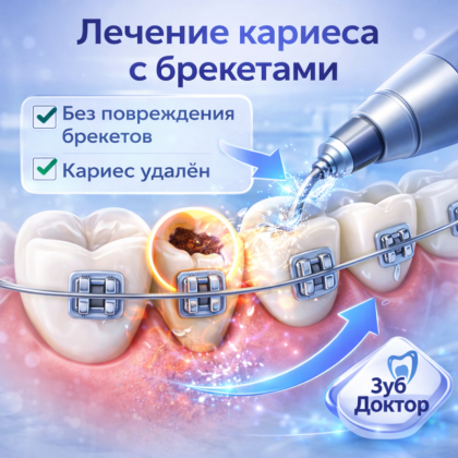 Кариес при брекетах