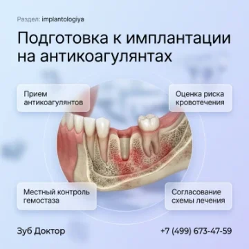 Подготовка к имплантации на антикоагулянтах