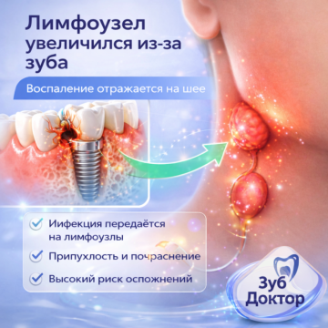 Лимфоузел увеличился из‑за зуба