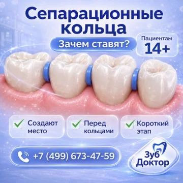 Сепарационные кольца перед брекетами: зачем их ставят