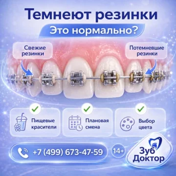 Темнеют резинки на брекетах: это норма или проблема