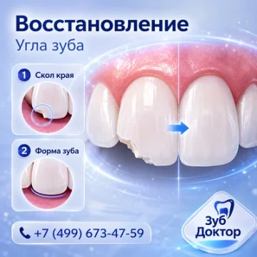 Восстановление угла переднего зуба: когда хватает пломбы