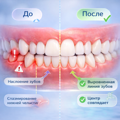 Брекеты