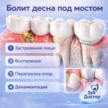 Болит десна под мостом