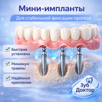 Мини-импланты