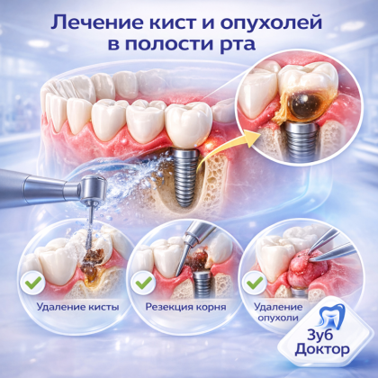 Кисты и опухоли во рту