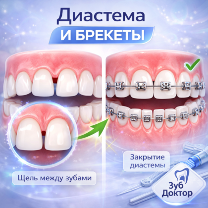 Диастема лечение брекетами в стоматологии