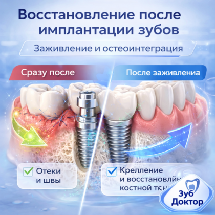 Период после имплантации зубов