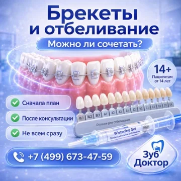 Брекеты и отбеливание: можно ли сочетать во время лечения