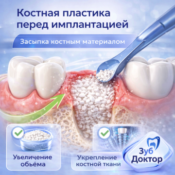 Наращивание костной ткани имплантация
