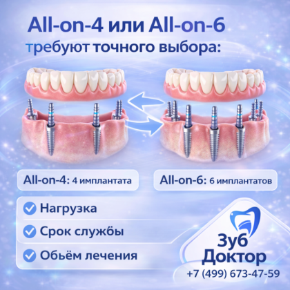 Что выбрать: All-on-4 или All-on-6