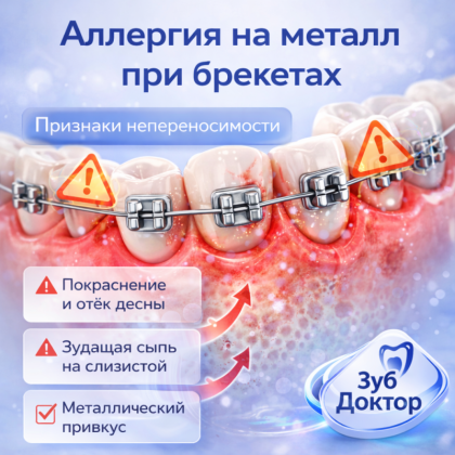 Аллергия на металл