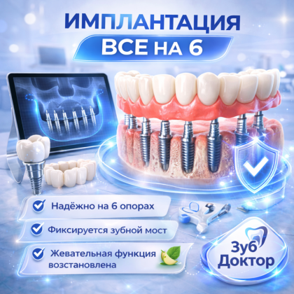 Имплантация зубов по методу All-on-6