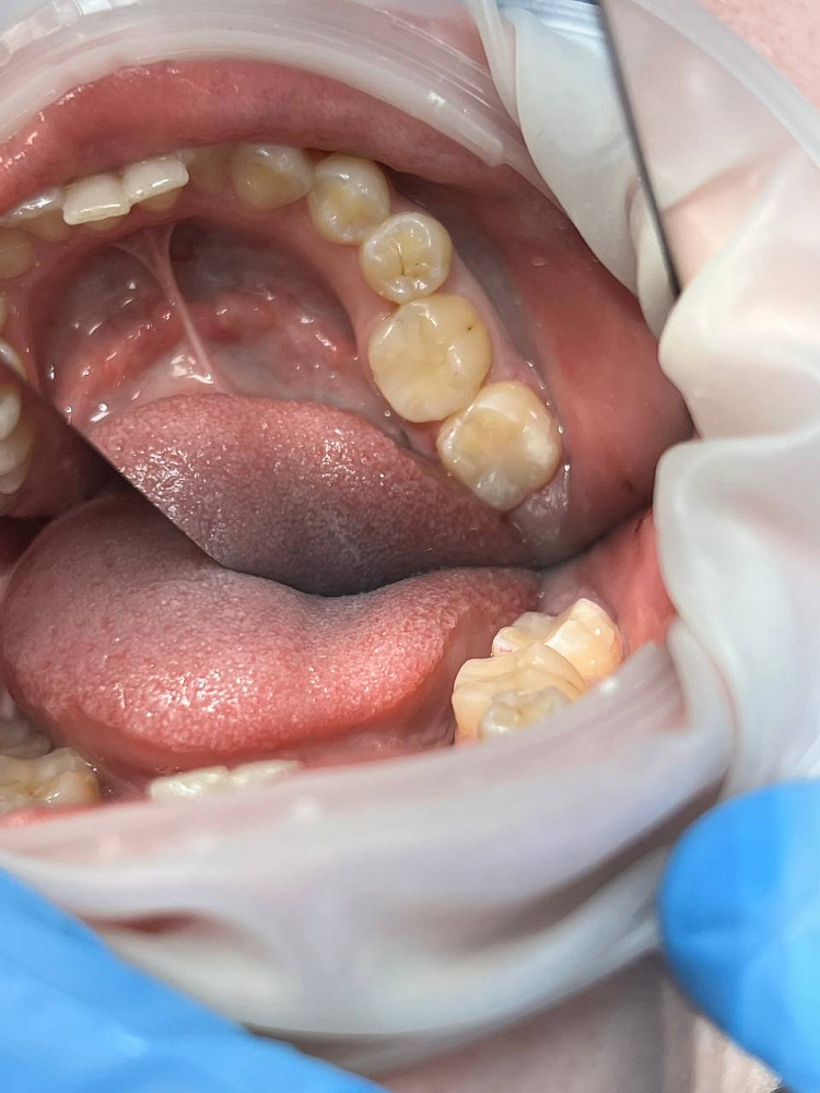 Результат после лечения