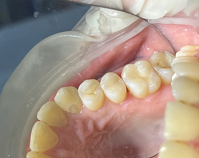 Результат после лечения: Лечение пульпита