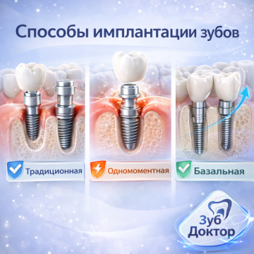 Способы Имплантации Зубов