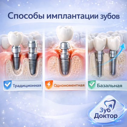 Способы Имплантации Зубов