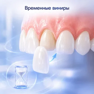Временные виниры: зачем их ставят