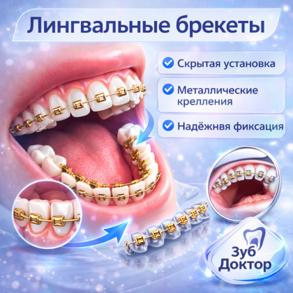Лингвальные брекеты