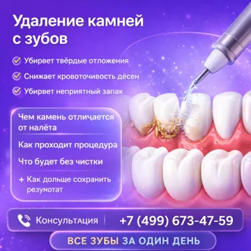 Удаление камней с зубов
