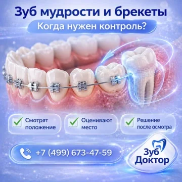 Зуб мудрости и брекеты: когда нужен контроль