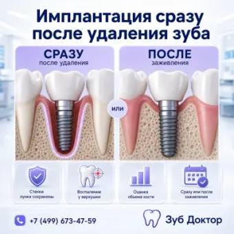 Удалять корень заранее или ставить имплант сразу