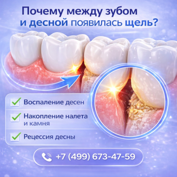 Зуб десна щель