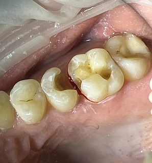 Состояние до лечения: Лечение пульпита